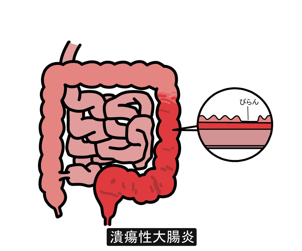 潰瘍性大腸炎とは